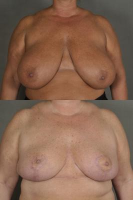 breast-reduction-p19.jpg
