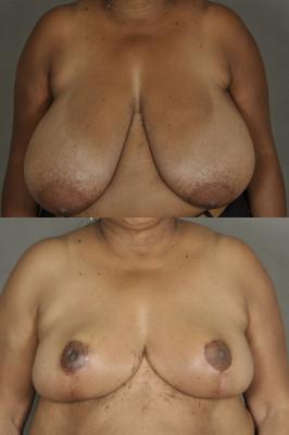 breast-reduction-p2.jpg