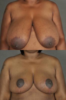 breast-reduction-p20.jpg