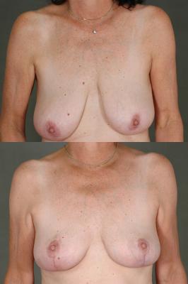 breast-reduction-p21.jpg