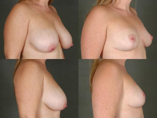 breast-reduction-p22_EzZhgRu.jpg