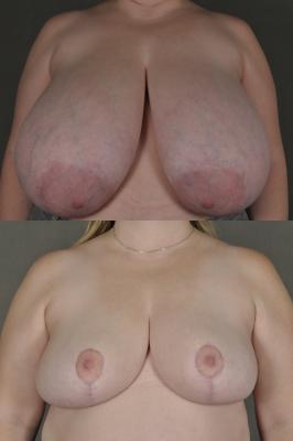 breast-reduction-p23.jpg