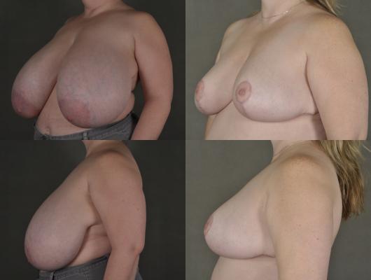 breast-reduction-p23_SETNszr.jpg