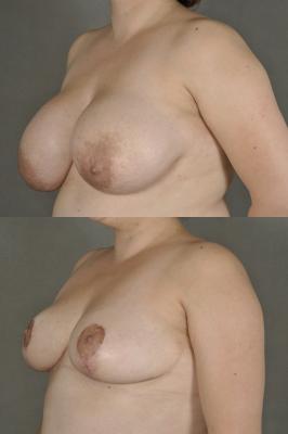 breast-reduction-p24_gFqTow0.jpg