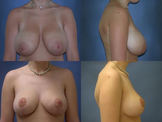 breast-reduction-p25.jpg