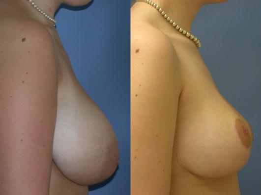 breast-reduction-p25_rMeniv8.jpg