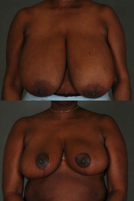 breast-reduction-p26.jpg