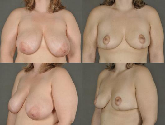breast-reduction-p27.jpg