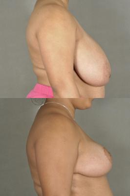 breast-reduction-p29_e6JtEYu.jpg