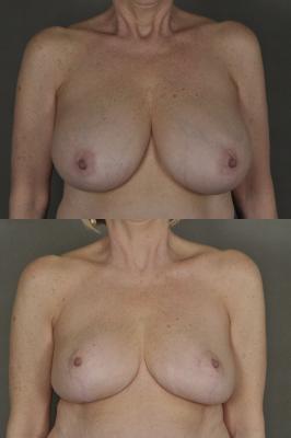 breast-reduction-p33.jpg