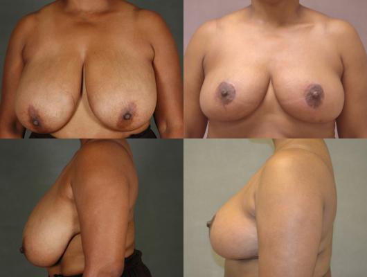 breast-reduction-p3_CdDFg8k.jpg