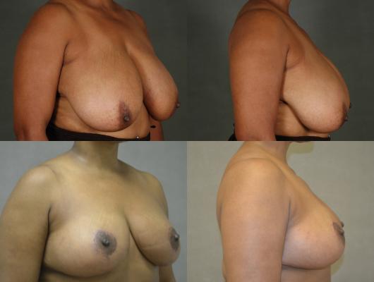breast-reduction-p3_DUsgDfr.jpg