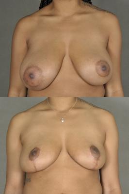 breast-reduction-p4.jpg