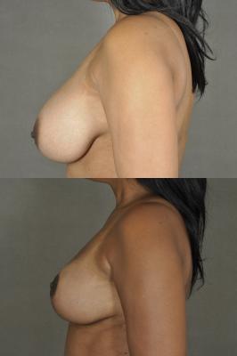 breast-reduction-p5_EAr6kuW.jpg