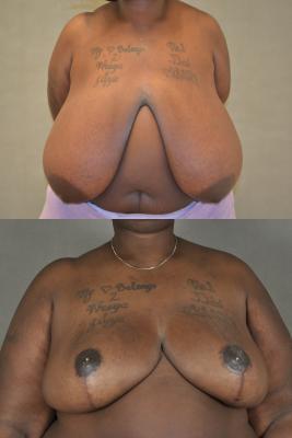 breast-reduction-p8.jpg