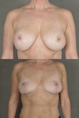 breast-revision-and-lift-p1.jpg