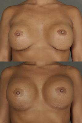 breast-revision-p1.jpg