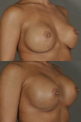 breast-revision-p1_J8GE94T.jpg