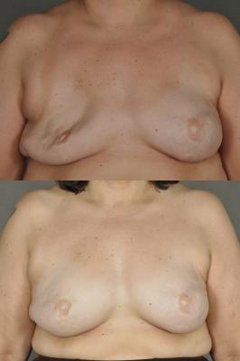 breast-revision-p4.jpg