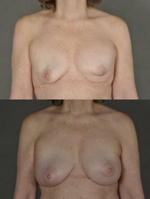 breast-revision-p5.jpg