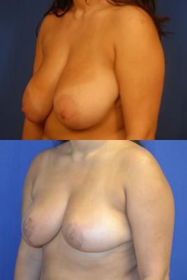 breast_reduc_4.jpg