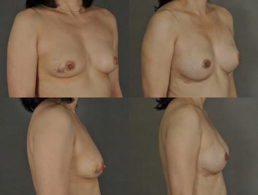 expander-breast-reconstruction-tummy-tuck-p9.jpg