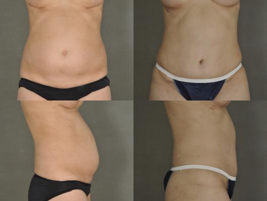expander-breast-reconstruction-tummy-tuck-p9_XalkYGT.jpg