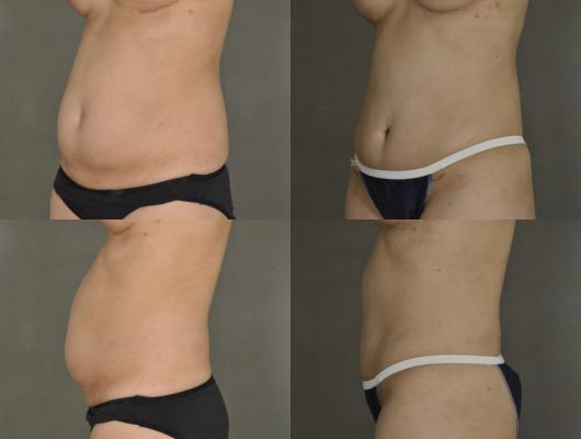 expander-breast-reconstruction-tummy-tuck-p9_pxOvCAM.jpg