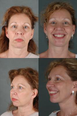 face-and-neck-lift-chin-implant-p1.jpg