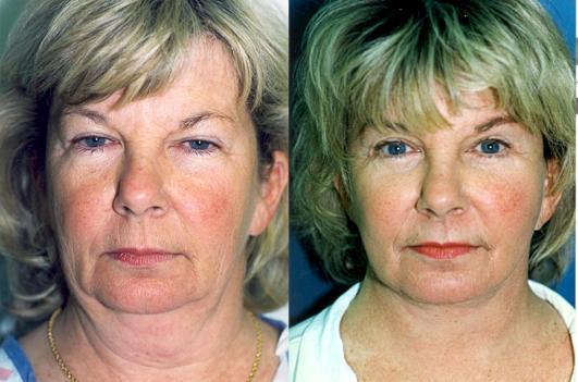 face-and-neck-lift-eyelid-surgery-p10_TDayIVz.jpg