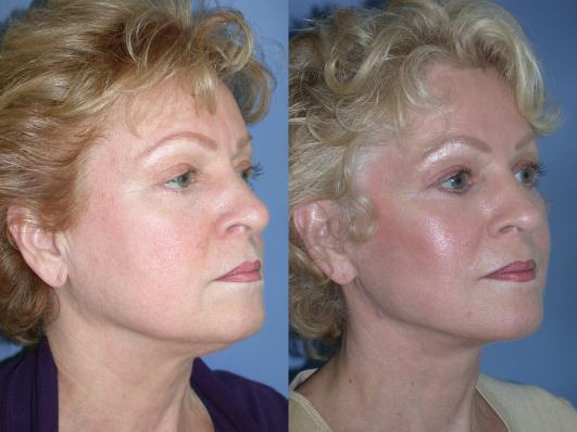 face-and-neck-lift-eyelid-surgery-p11_GerT97q.jpg