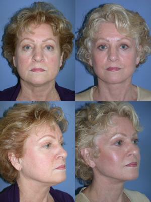 face-and-neck-lift-eyelid-surgery-p11_p1vKrhO.jpg