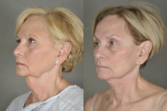 face-and-neck-lift-eyelid-surgery-p12.jpg