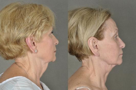 face-and-neck-lift-eyelid-surgery-p12_cwC5kFf.jpg