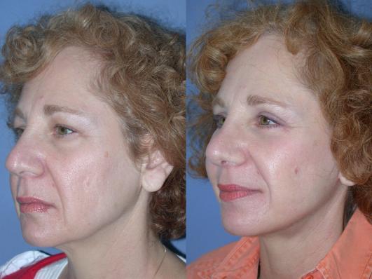 face-and-neck-lift-eyelid-surgery-p15.jpg