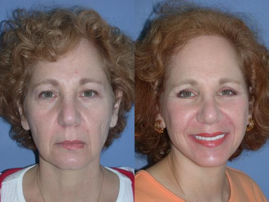 face-and-neck-lift-eyelid-surgery-p15_2E9FQPM.jpg