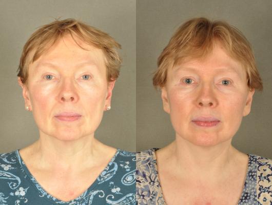 face-and-neck-lift-eyelid-surgery-p16.jpg