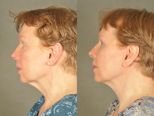 face-and-neck-lift-eyelid-surgery-p16_LAP35V6.jpg