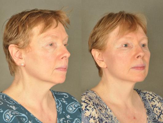 face-and-neck-lift-eyelid-surgery-p16_qu3iKHm.jpg