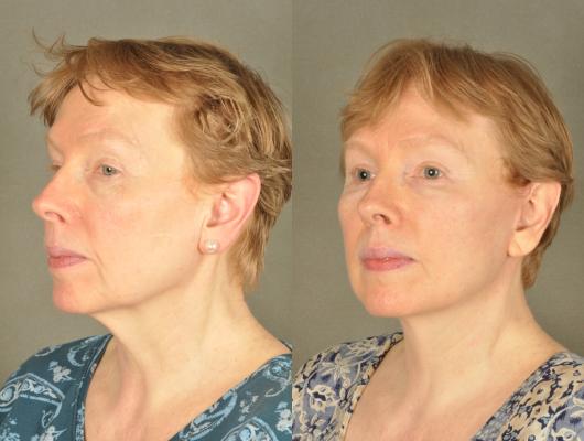 face-and-neck-lift-eyelid-surgery-p16_rMhwtVB.jpg