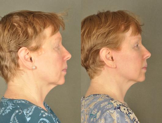 face-and-neck-lift-eyelid-surgery-p16_yMZtjCg.jpg