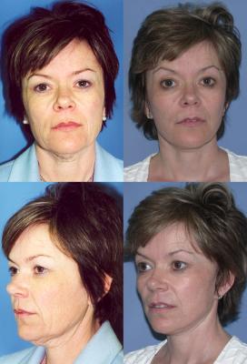 face-and-neck-lift-eyelid-surgery-p2_H10jouu.jpg