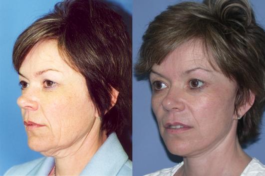 face-and-neck-lift-eyelid-surgery-p2_JSeWsvQ.jpg