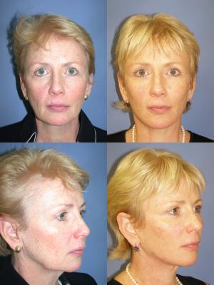 face-and-neck-lift-eyelid-surgery-p3.jpg