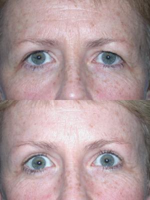 face-and-neck-lift-eyelid-surgery-p3_2Y7J7LK.jpg