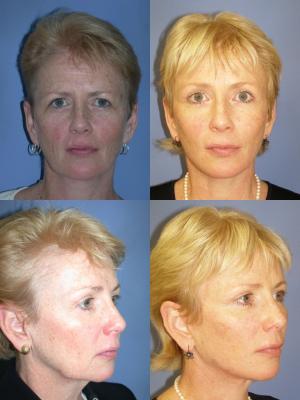 face-and-neck-lift-eyelid-surgery-p3_8eyezIi.jpg