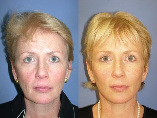 face-and-neck-lift-eyelid-surgery-p3_rXlrJKs.jpg