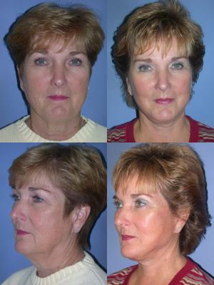 face-and-neck-lift-eyelid-surgery-p4_S8NN3lw.jpg