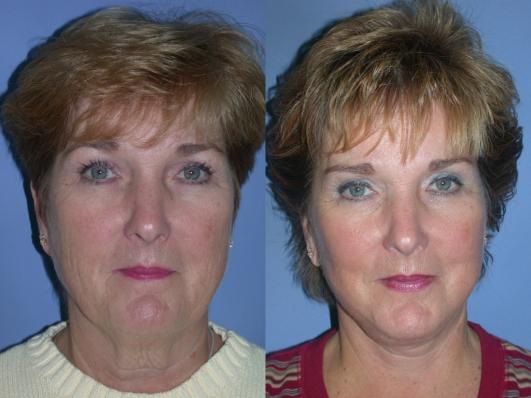 face-and-neck-lift-eyelid-surgery-p4_vqBisT9.jpg