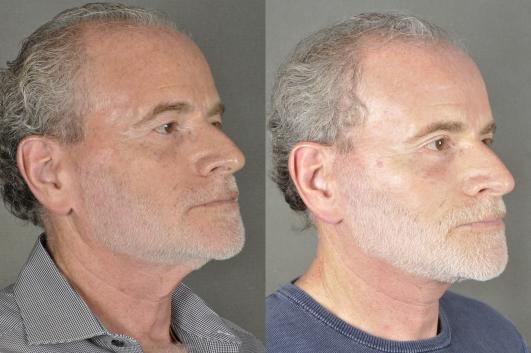 face-and-neck-lift-eyelid-surgery-p5_m2r0v3t.jpg